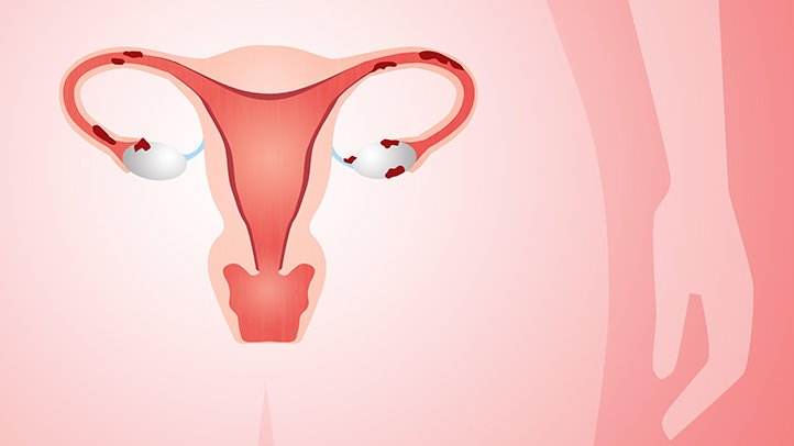 子宫内膜异位症找代孕可以吗？
