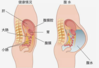 试管婴儿取完卵从哪些症状判断有腹水？