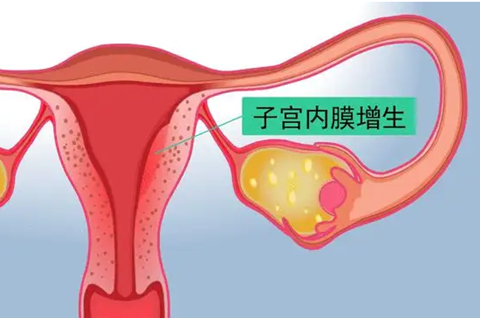 子宫增生到底是怎么造成的?子宫内膜增生能做试管吗?